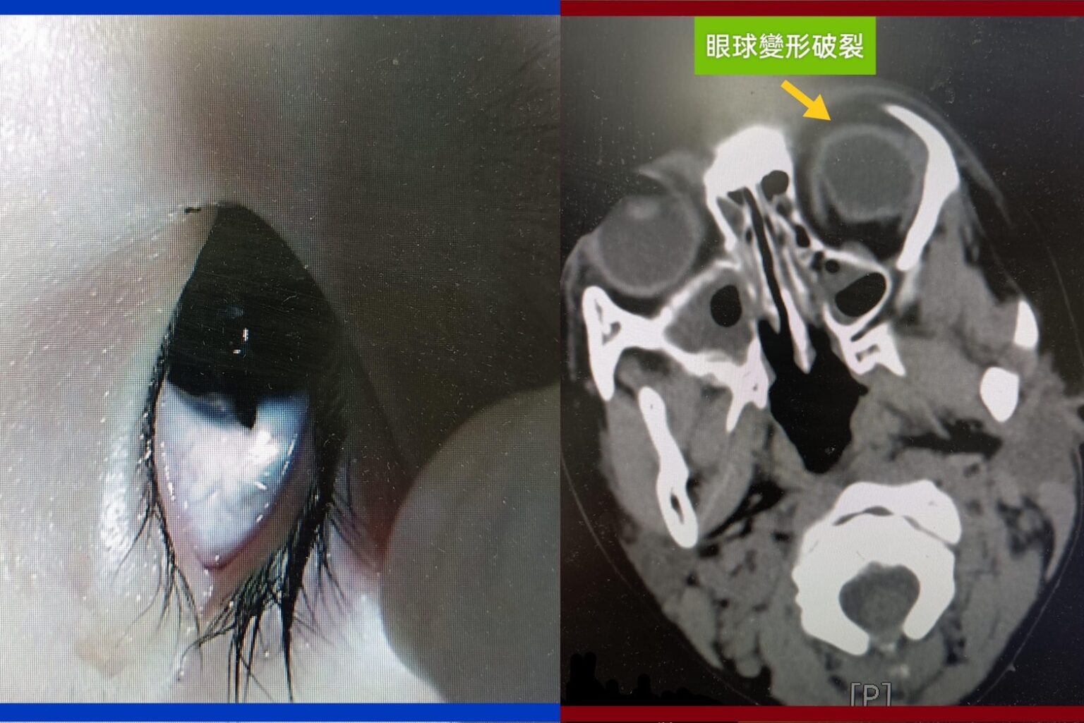 家長注意!4歲女童眼球誤遭美工刀劃破 醫師籲家長留意幼童安全